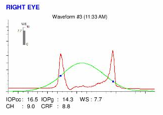 ocular response analyzer signals, waveforms