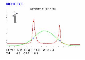 ocular response analyzer, pellucid marginal degeneration PMD hysteresis waveform