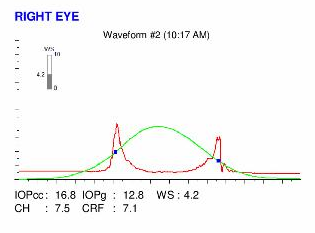 ocular response analyzer examination in an eye after PRK